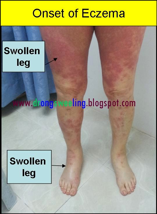 TCM News TCM Eczema Treatment for Eczema, Psoriasis, Best TCM Doctor