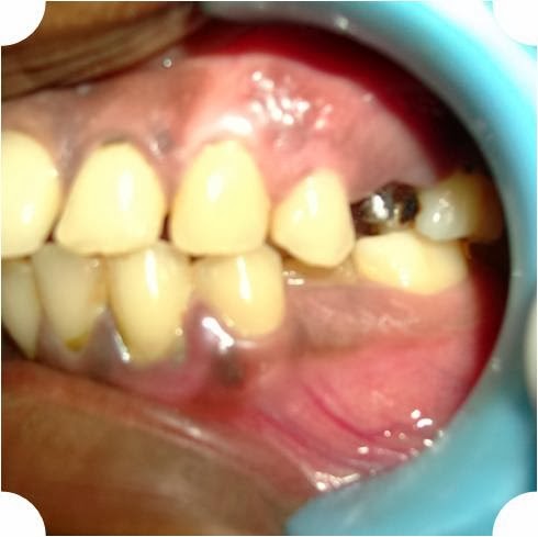 zirconia mature singles La question : je suis sous pompe à insuline depuis 2 mois et les résultats de ma glycémie sont catastrophiques le schéma basal a été modifié il y a un mois. zirconia mature singles La question : je suis sous pompe à insuline depuis 2 mois et les résultats de ma glycémie sont catastrophiques le schéma basal a été modifié il y a un mois.
