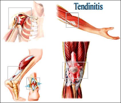 TENDONES TENDINITIS tendones tendinitis: