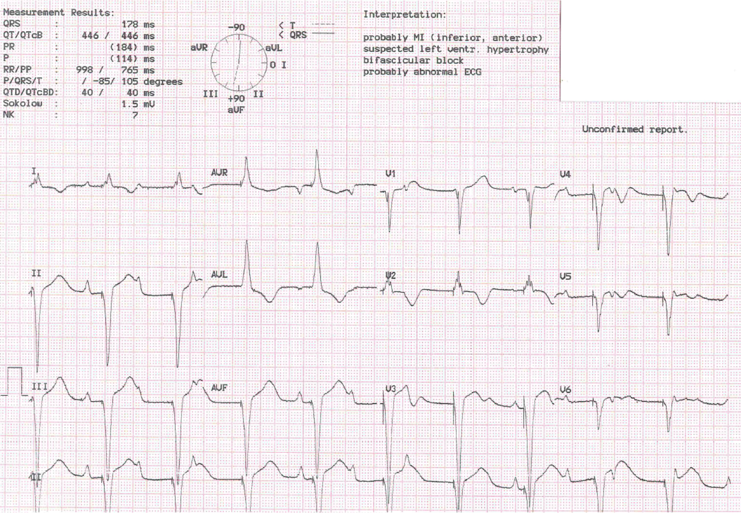 Single-chamber versus dual-chamber pacing for high-grade atrioventricular block