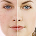 Tips Cara Menghilangkan Jerawat Dan Bekasnya Secara Alami Dan Cepat thumbnail