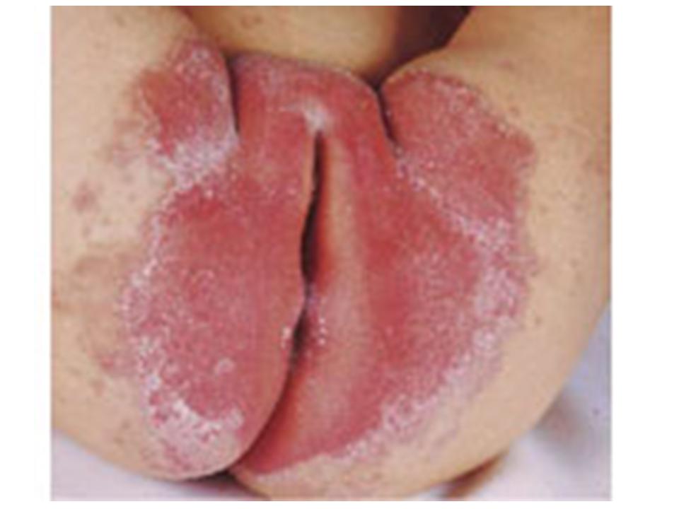 Baby Nappy Rash