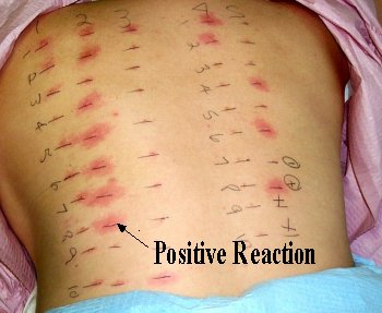 mtf estradiol patch dosage mtf estradiol patch dosage