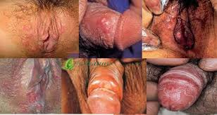 contoh sipilis obatsipilis-tradisional.blogspot.com