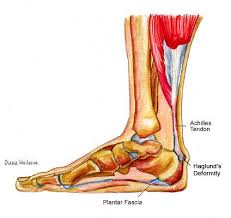 Pain in the Back of Your Heel? - The Tampa Podiatrist
