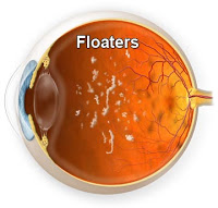 how-to-get-rid-of-floaters-in-eyes