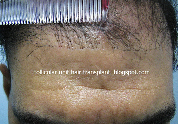 hairline design in hair transplant