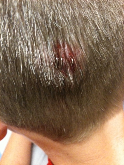 Beveled Laceration
