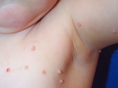 Picture of Molluscum Contagiosum 