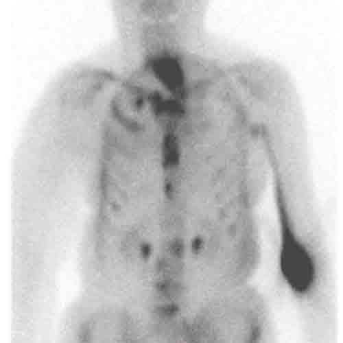 Nuclear Medicine Technology Program: Extravasation