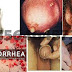 Obat Gatal2 Pada Kelamin Yang Keluar Nanah thumbnail