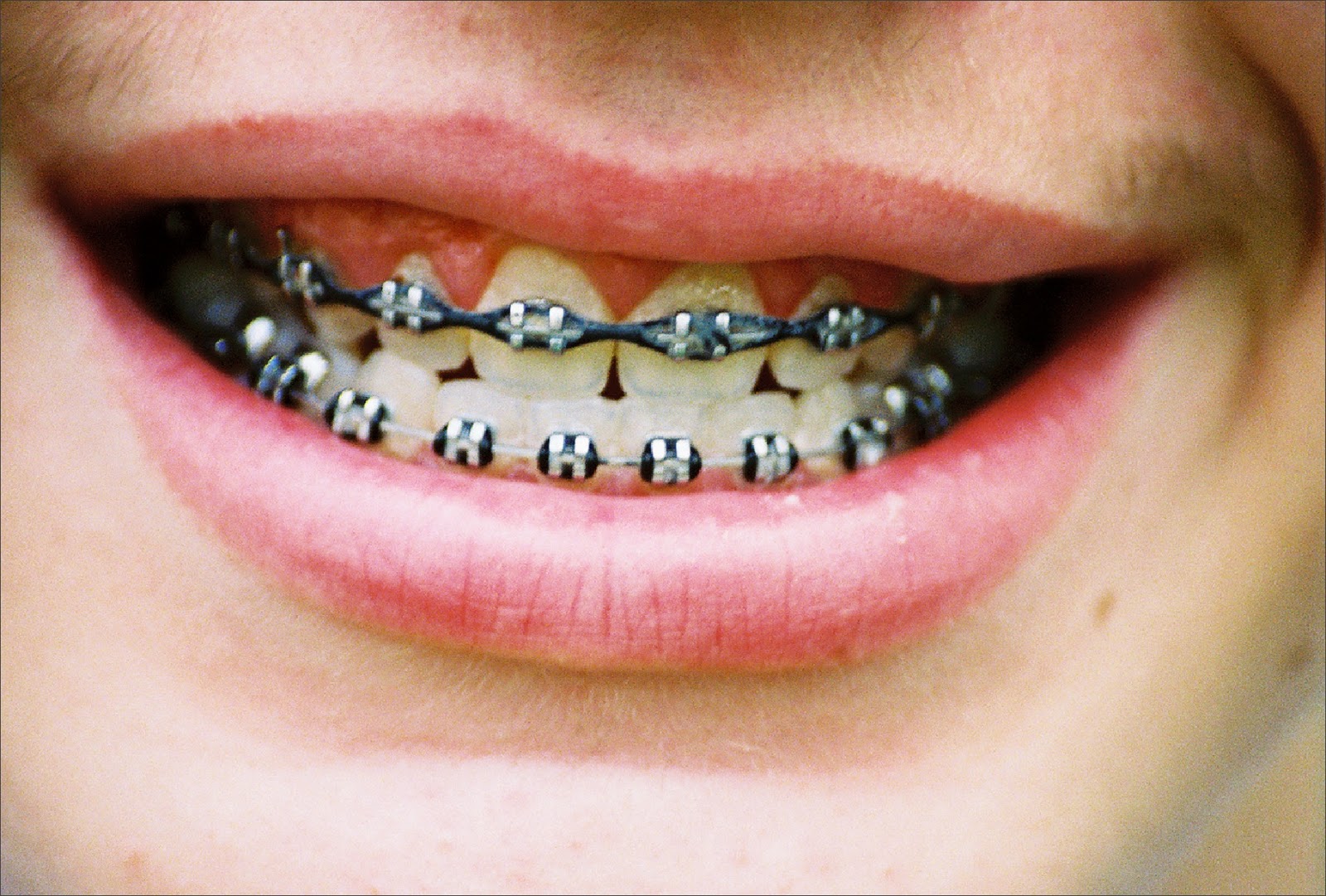 with braces no more geeky metal braces with clear options from invisalign with braces no more geeky metal braces with clear options from invisalign