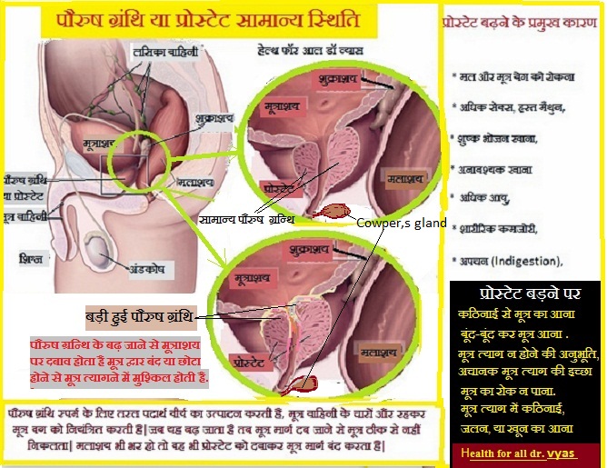Prostate enlargement (BPH)