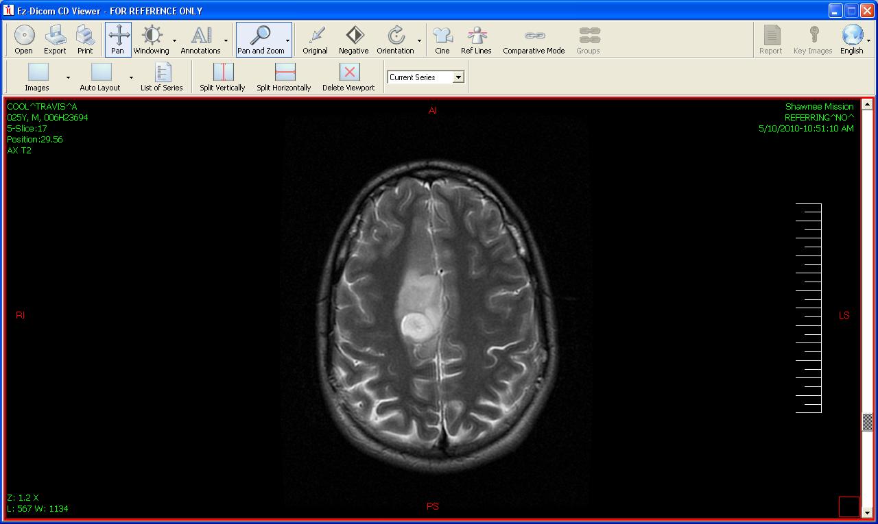 Brain Nut