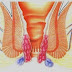 Obat Wasir India thumbnail