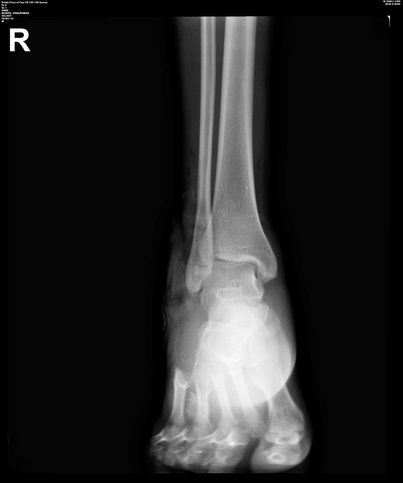 Fracture Dislocation FRACTURE DISLOCATION LATERAL COLUMN FOOT-4.bp.blogspot.com