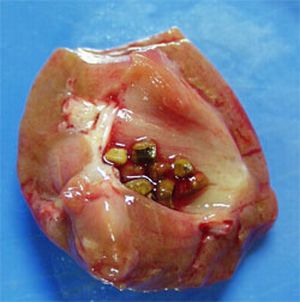 kidney stone causes and treatment health and safety size of kidney stones
