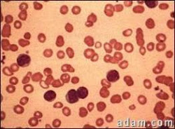 Globulos en leucemia