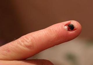 The nail finally fell off my damaged little finger The nail finally fell off my damaged little finger