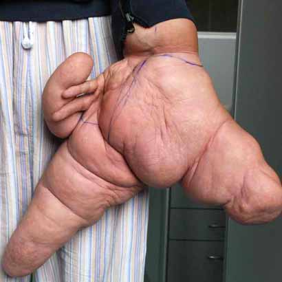 A Chinese man has world's largest hand which was deformed from birth A Chinese man has world's largest hand which was deformed from birth