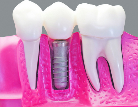 Dental implants are most favoured, but they are costly, time-consuming, too expensive and may not be suitable for poor health.