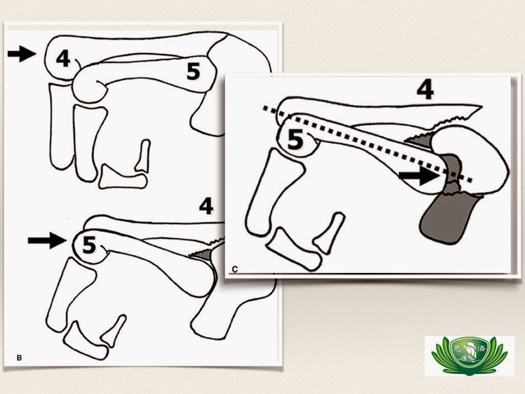 Comminuted Fracture 當第四掌指骨受到力量,造成基底部骨折後,第五指 -4.bp.blogspot.com