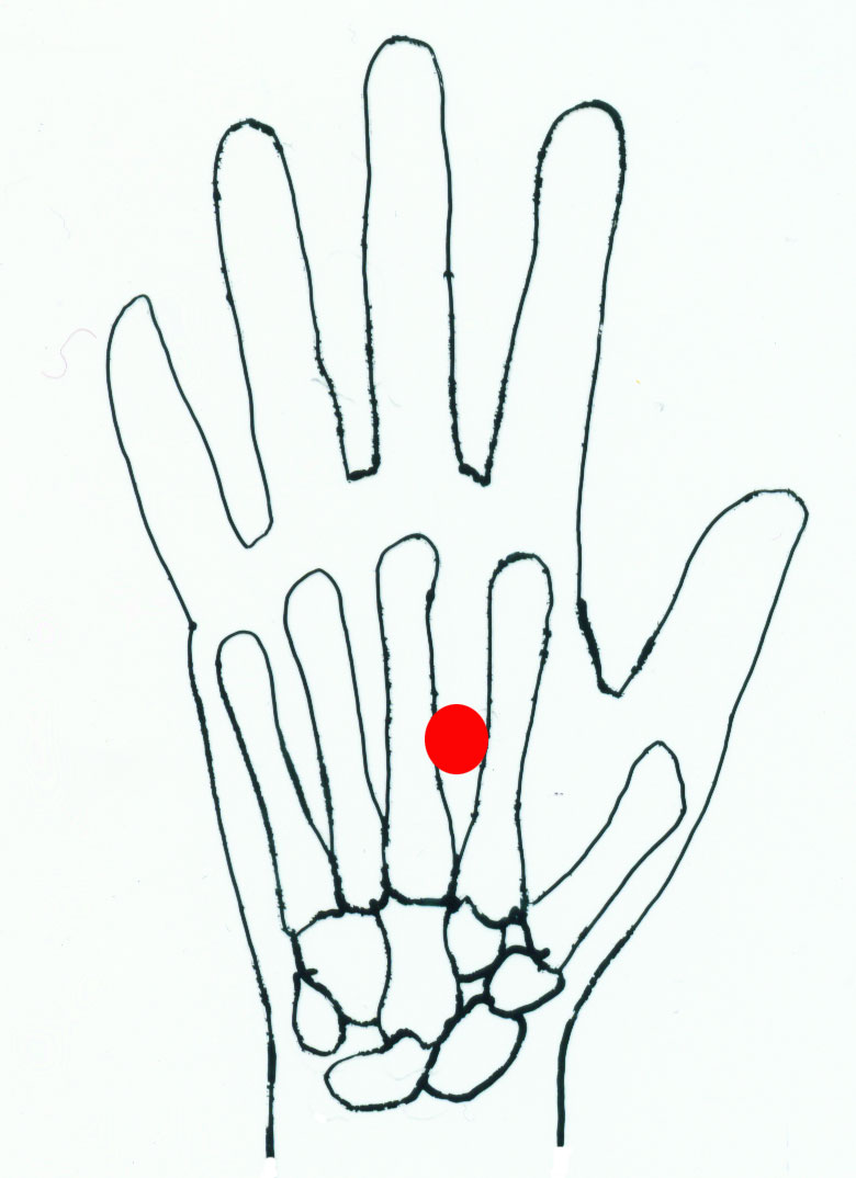 Point LAO GONG - one of the most important points of acupuncture 89 Point LAO GONG - one of the most important points of acupuncture 11