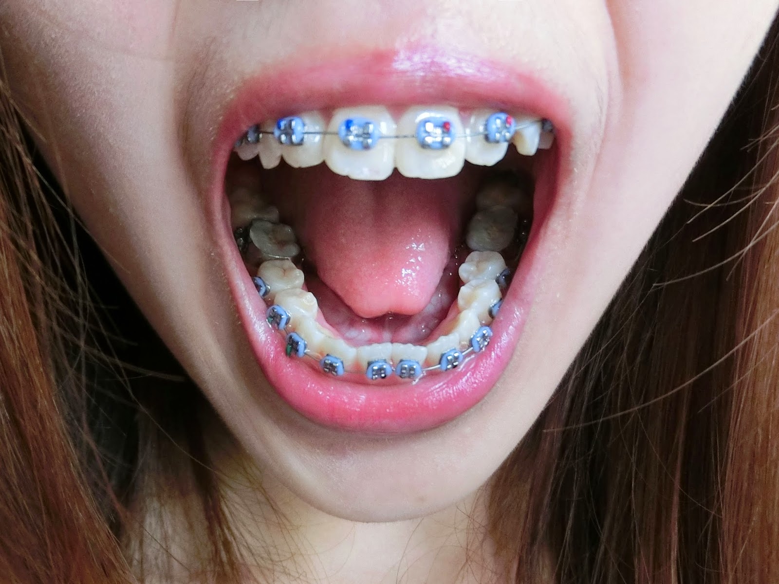 Bernice Lim My Braces Journey PART 1