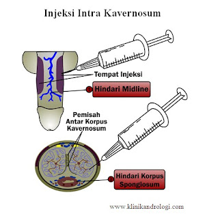 Injeksi IntraKavernosum
