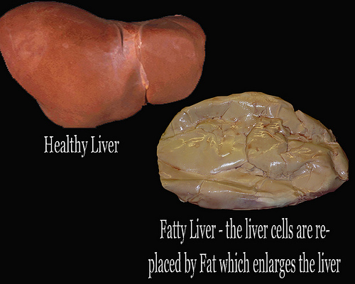 fatty+liver.jpg