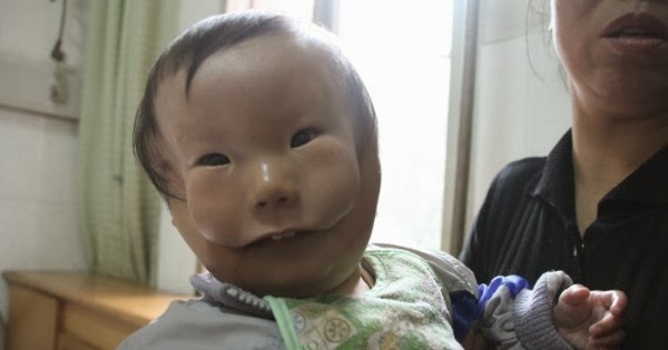 Baby Born In China With Second Face : Unusual Facial Deformity