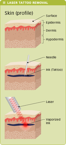 Tattoo Removal Before And After Tattoo Removal Before And After