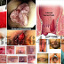 Nama Obat Ambeien Daun Ungu Bentuk Kapsul thumbnail