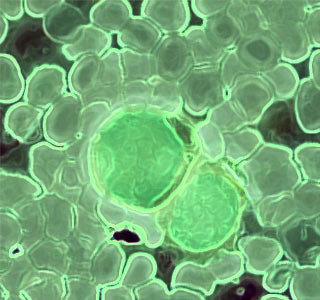Leukemia cells treatment against Leukemia