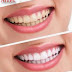 Estética Dental-Blanqueo de Dientes
