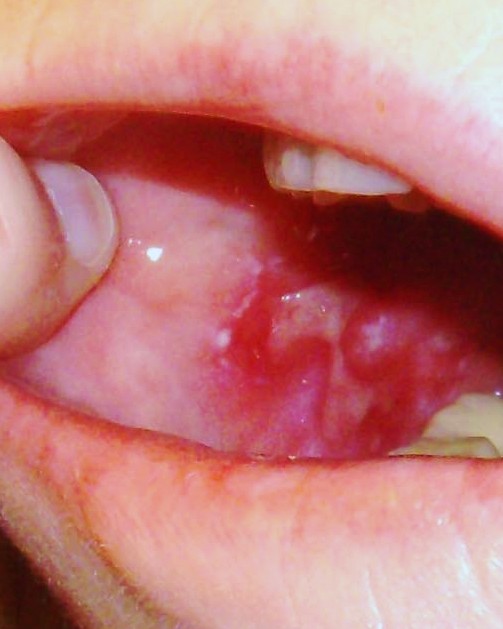 Diabetic Mouth