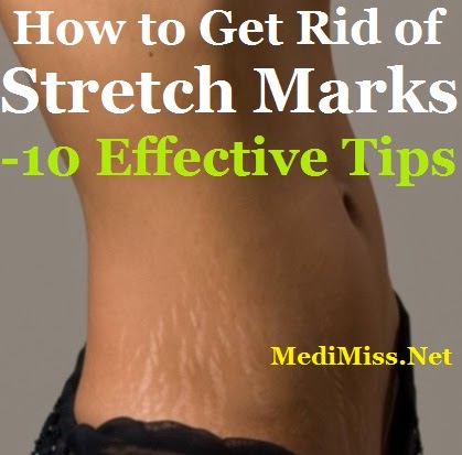 Stretch Marks - 10 Effective Tips How to Get Rid of Stretch Marks - 10 Effective Tips