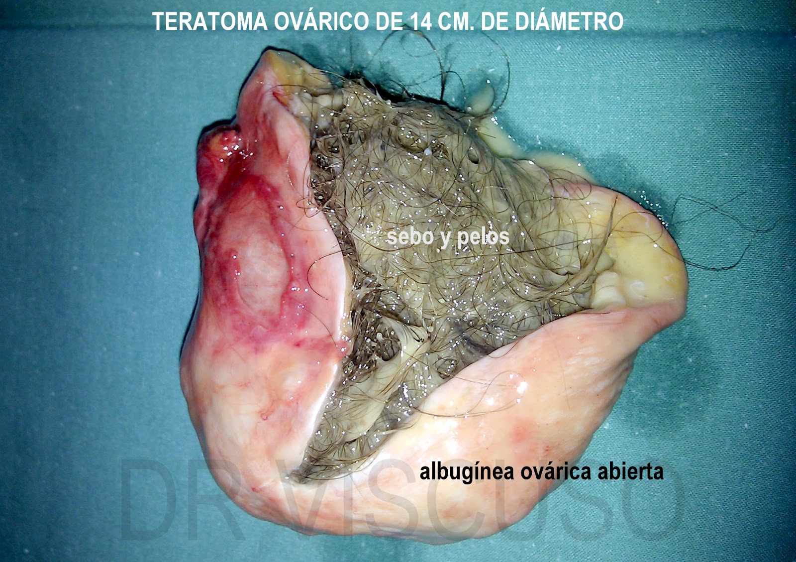Teratoma Ovarico