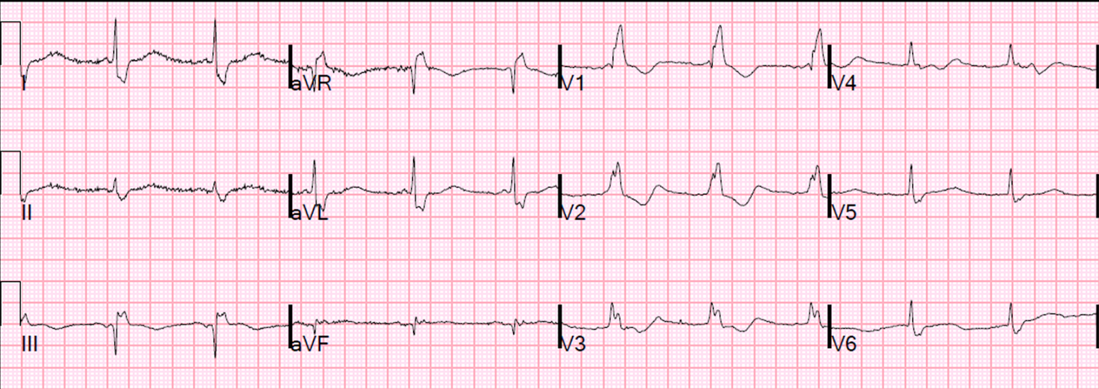 dr smiths ecg blog pseudostemi and true st elevation in rbbb ecg