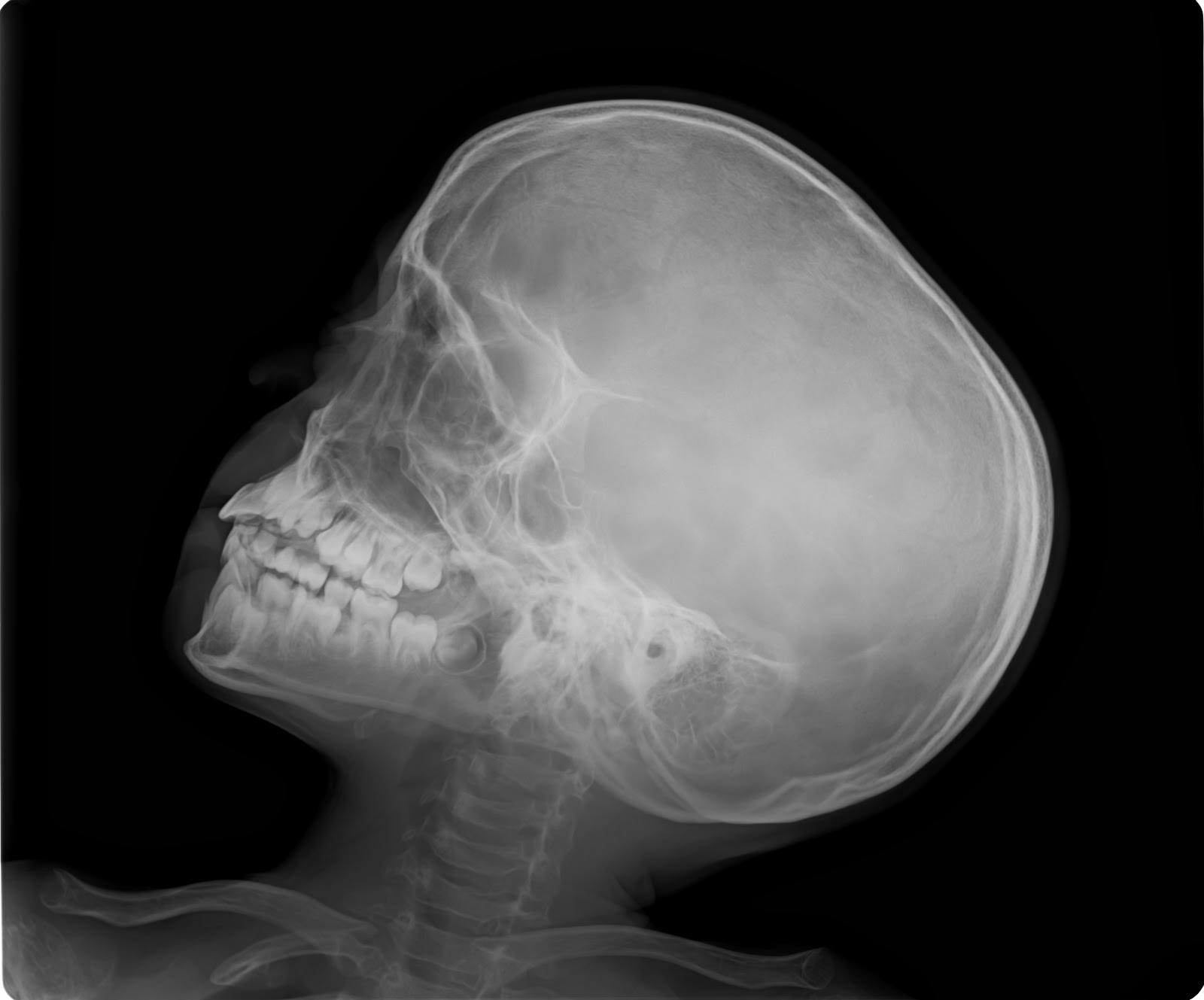 PseudoachondroplasiaCase Report Sumer's Radiology Blog