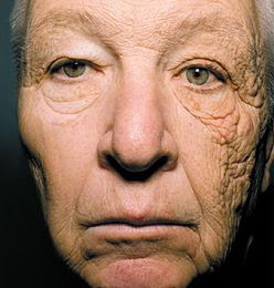 Dermatoheliosis unilateral