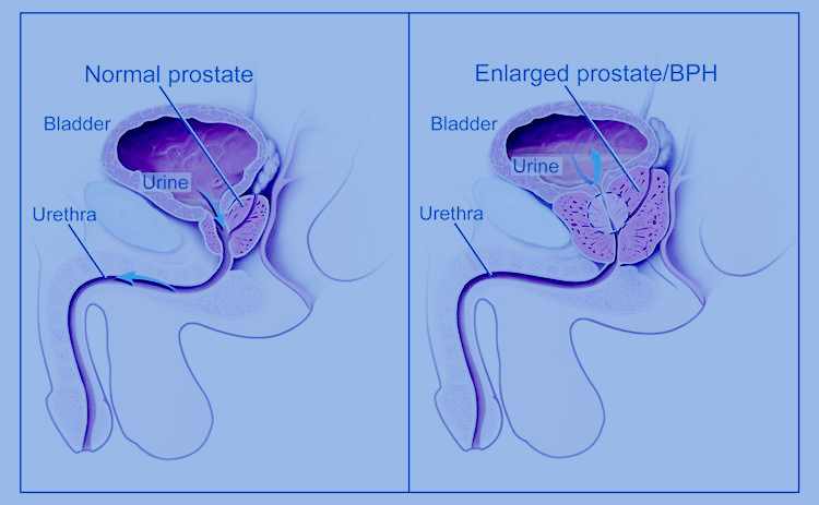 Testicular pain blue balls