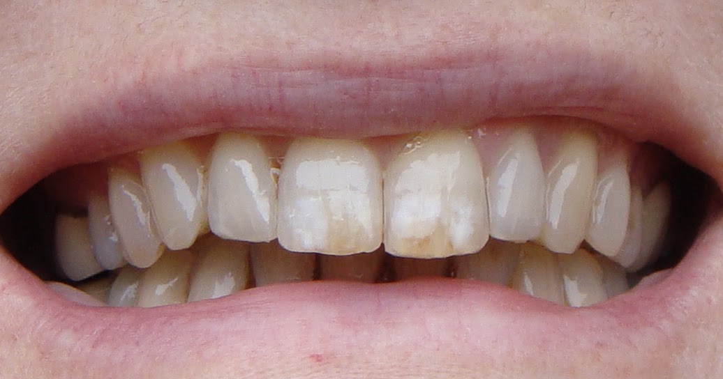 Braces at 56 Should I have an Inspire Ice Brace fitted to finish off