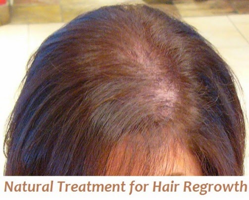 How To Regrow Hair Naturally Using Home Remedies How To Regrow Hair Naturally Using Home Remedies