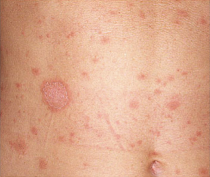 Les premiers signes du psoriasis commençant