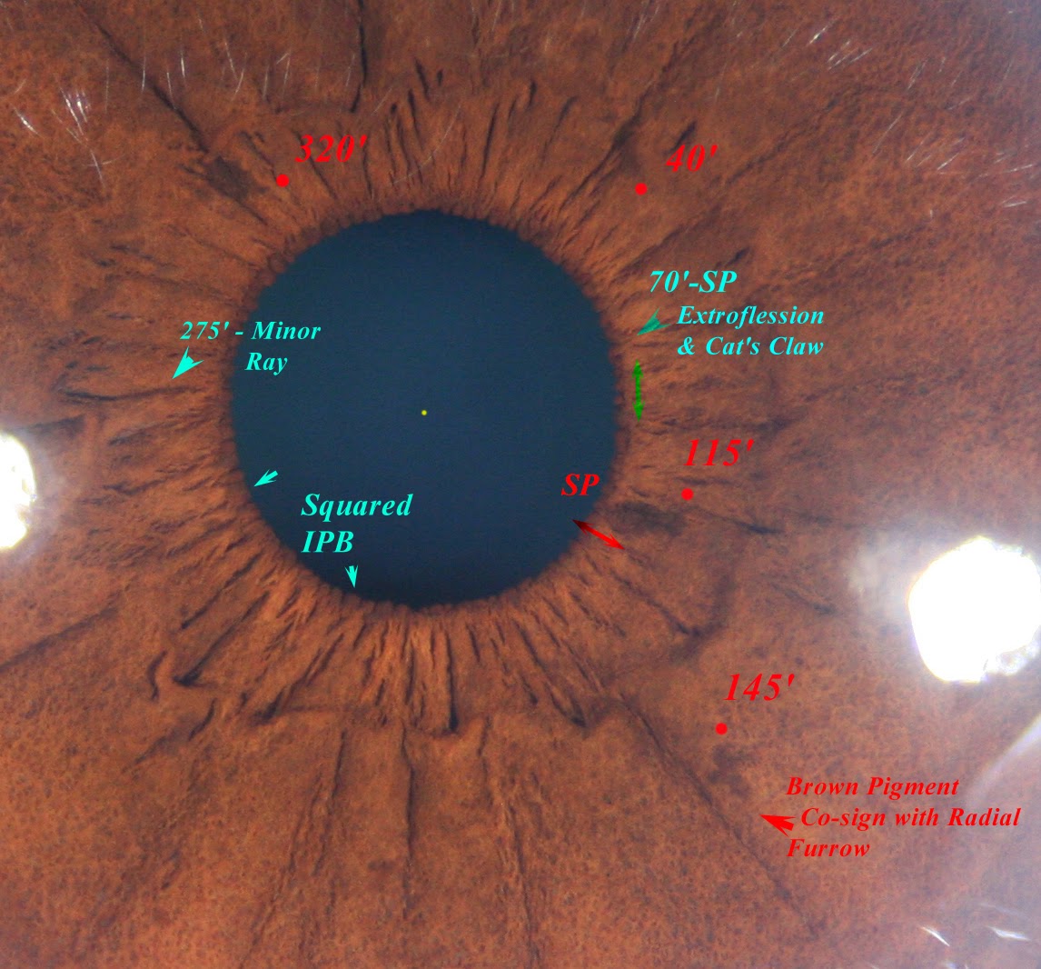 Modern & Multidimensional Iridology MI Analysis of the Iris Pigmentation & Combination Signs