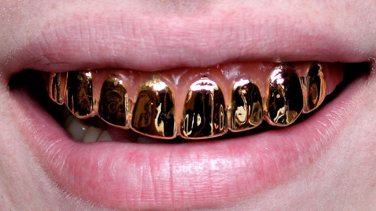 Gold Braces For Teeth Gold Choices