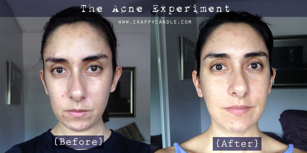 I Didn't Wash My Face for a Month The Acne Experiment Crappy Candle