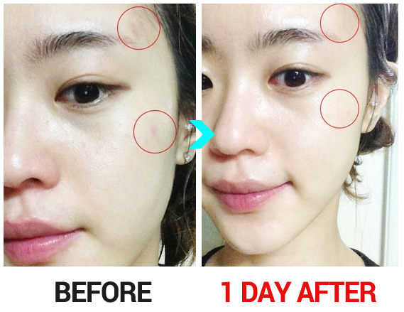 Of Ways Rid Overnight Scars Get Acne To Of Ways Rid Overnight Scars Get Acne To