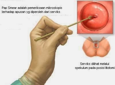 Obat Alami Polip Serviks Obat Alami Polip Serviks